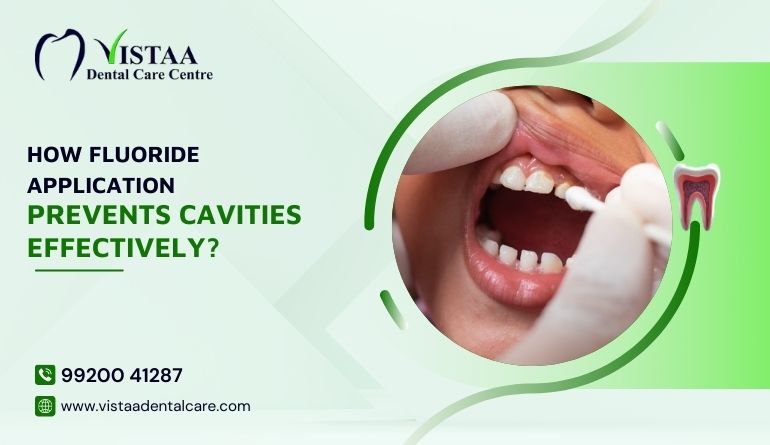 How Fluoride Application Prevents Cavities Effectively?