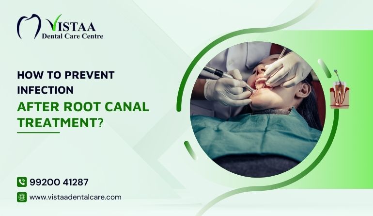How to Prevent Infection After Root Canal Treatment?