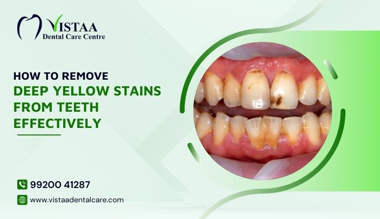 How to Remove Deep Yellow Stains from Teeth Effectively